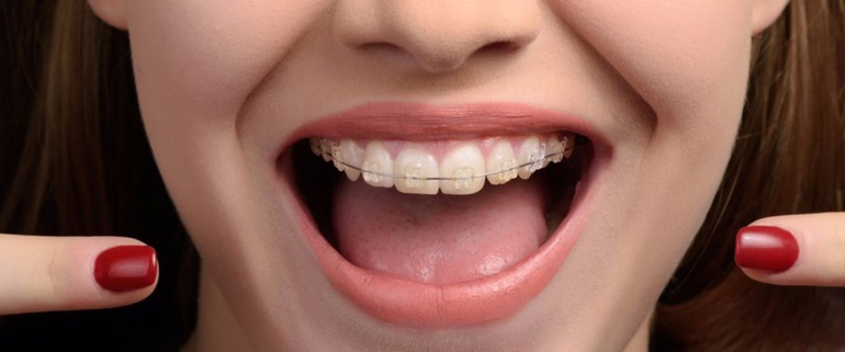 Diş Telinin Temizliğini Nasıl Yapabilirim?